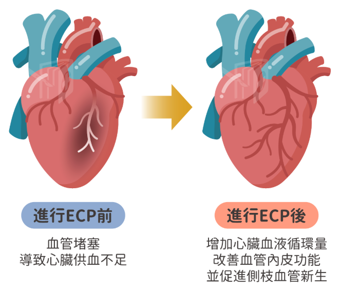 心血管專家 ：體外反搏（僅提供資訊）康博診所
